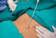 Vaser Liposuction Yağ Aldırma Nedir?