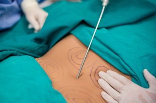 Vaser Liposuction Yağ Aldırma Nedir?