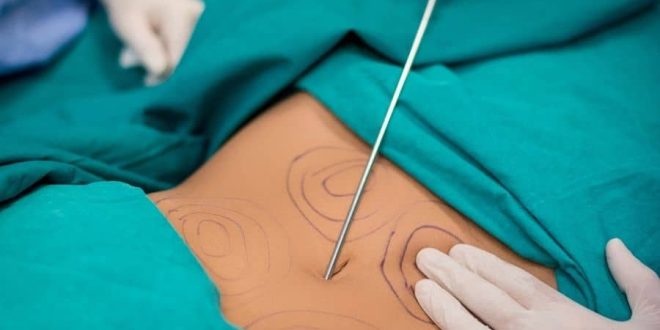 Vaser Liposuction Yağ Aldırma Nedir?
