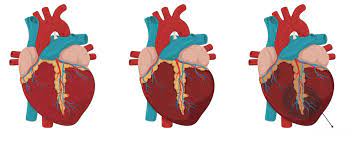 Kalp Krizi Testi Nedir?